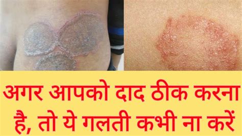 Fungal Infection Mistakes Dr Naval Patel Aura Clinic Raigarh Youtube