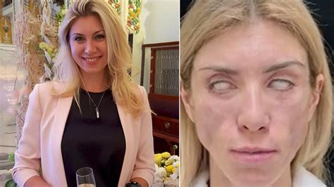 plastic surgery experiences russian beauty queen says she s ‘disfigured after 5 000 treatment