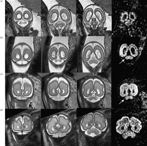 Mri Of Normal Fetal Brain Development European Journal Of Radiology