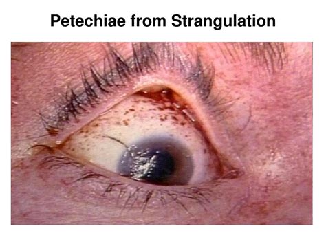 Petechiae From Strangulation