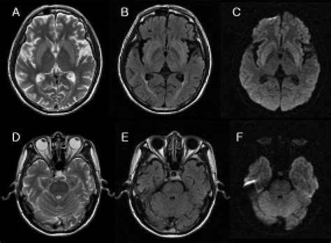 Brain Magnetic Resonance Imaging Mri Scans T2 Weighted Images Show