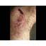 A Scab Healing  YouTube