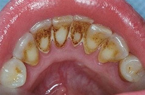 How to get rid of coffee stains on teeth permanent | top 3 home remedies to remove coffee stains from teethhow can you save your teeth from everlasting. How To Remove Plaque Without Going To The Dentist ...