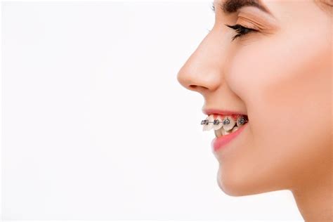 Overbite Correction With Braces Dental Specialist Dentaltown