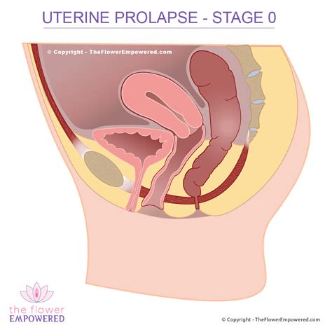 Uterine Prolapse Prolapsed Uterus Pelvic Organ Prolapse Stage To The Best Porn Website