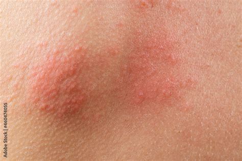 Chickenpox Rash Shingles Varicella Zoster Virus Skin Rash And
