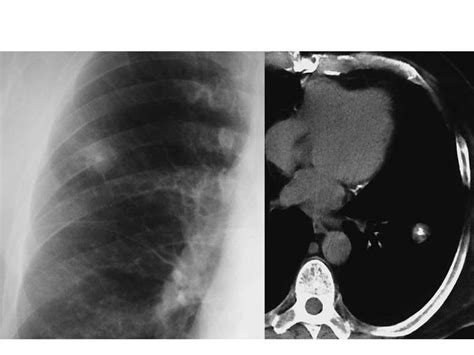 Know Solitary Pulmonary Nodule In A Simple Way Radiology