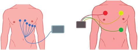 The Placement Of The Ecg And Pem Electrodes Download Scientific Diagram
