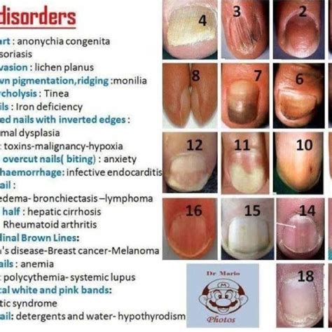 Nail Diseases And Disorders Chart