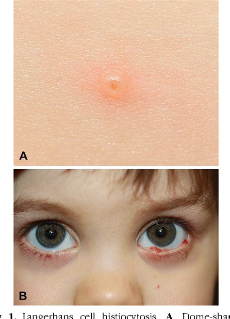 Figure 1 From Chemotherapy Induced Acral Erythema Sparing The Palms