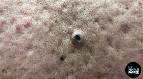 Dr Pimple Popper See The King Of All Blackheads Explode