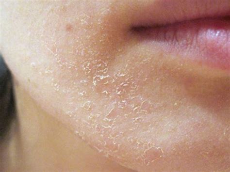 Dry Skin Around Mouth Causes And Treatment Healthlifevs