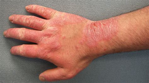 Itching (pruritus) is an unpleasant sensation where the skin signals a reflex response to tearing of the skin. Rash: 22 Common Skin Rashes, Pictures, Causes, and Treatment