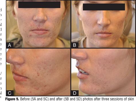 Table 3 From Practical Evaluation And Management Of Atrophic Acne Scars