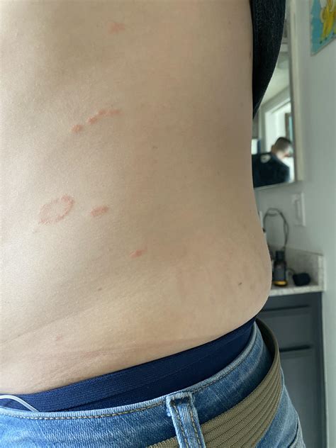 Start Of Pityriasis Rosea The Oval Spot Was The First Spot Then Over