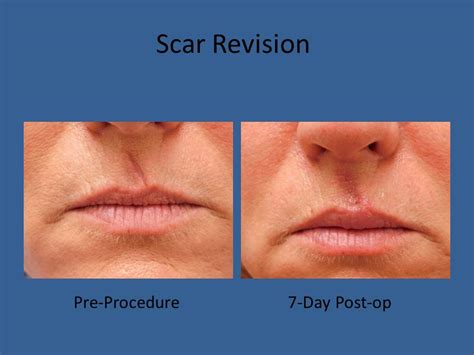 Scar Revision Before And After Photos Connecticut