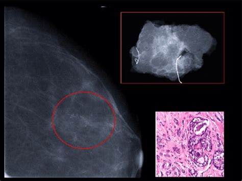 Figure 1 From Imaging Spectrum Of Breast Focal Fibrocystic Changes