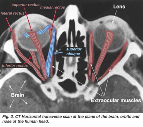 Ct Scan Tips And Protocols Rectus Muscles In Orbit Ct