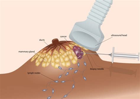 diagnosis and staging of inflammatory breast cancer things health