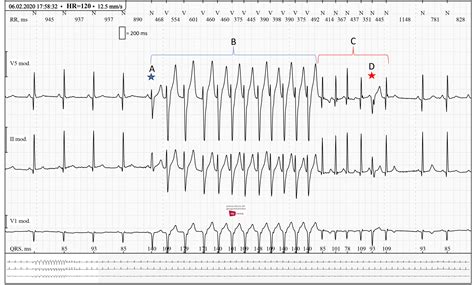 Ventricular Tachycardia Vs Supraventricular Tachycardia
