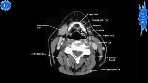 Ct Scan Of Neck Study Part Youtube