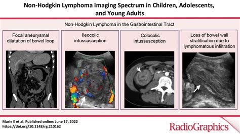 Non Hodgkin Lymphoma Imaging Spectrum In Children Adolescents And