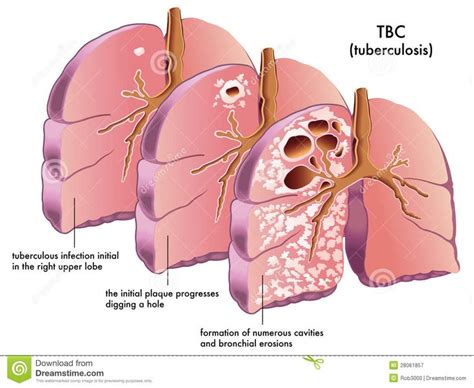 Tuberculosis TB In The United States Tuberculosis Medical