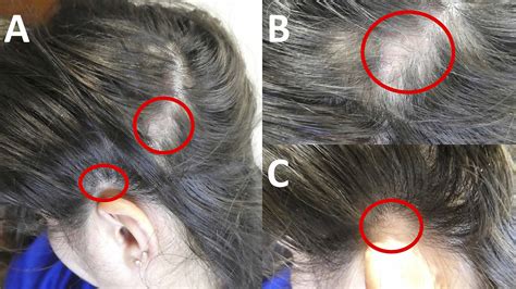 Scalp Biopsy For Hair Loss Doctorvisit