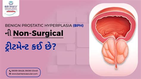 Best Nonsurgical Treatment For Benign Prostatic Hyperplasia Prostatic Artery Embolization