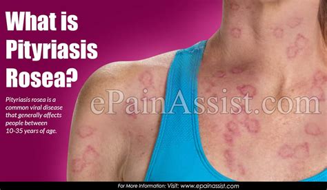 Pityriasis Rosea Images Picture Of Pityriasis Rosea Get Information