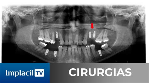 Split Crest Superior Com O Uso Do Extra Graft Xg 13 E Implantes