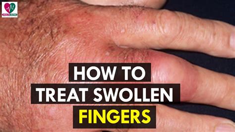 How To Treat Swollen Fingers Health Sutra Youtube