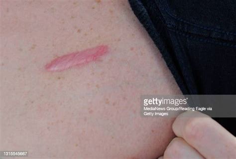 Pacemaker Scar Photos And Premium High Res Pictures Getty Images