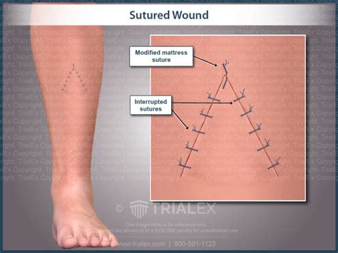 Sutured Wound Trialexhibits Inc