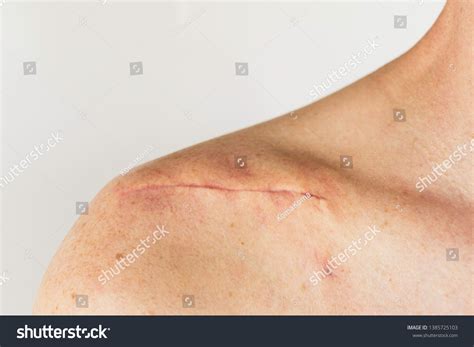 Scar On Male Body After Surgery Stock Photo Edit Now 1385725103