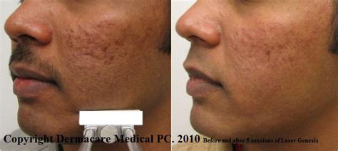New York Pore Reduction Skin Rejuvenation Fine Lines
