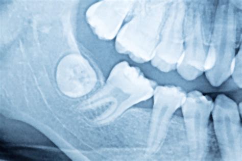Serious Complications From Impacted Wisdom Teeth Top Cosmetic Dentist