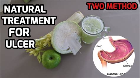 Cabbage Juice Remedy Healing For Stomach Ulcers And Other Stomach