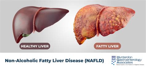 Non Alcoholic Fatty Liver Disease Nafld Hunterdon Gastroenterology Associates Digestive