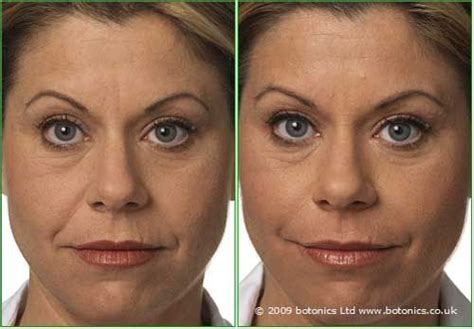 Dermal Fillers Before And After Photos Instantly Ease Wrinkles Wrinkle