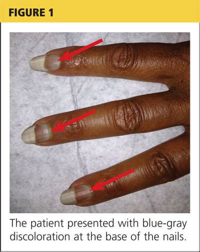 Lupus Red Nail Beds Bios Pics