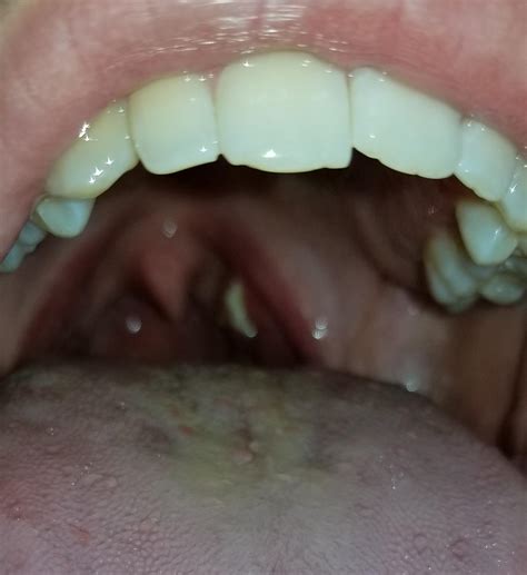 Is This A Tonsil Stone How Do I Get This Out Of My Mouth Ent