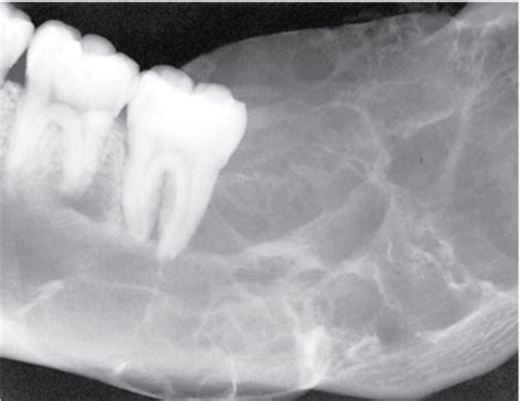 Ch Recognizing Normal Radiographic Anatomyintraoral Radiographs