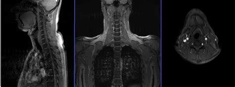 Cervical Spine Mri Protocols And Planning Indications For Mri