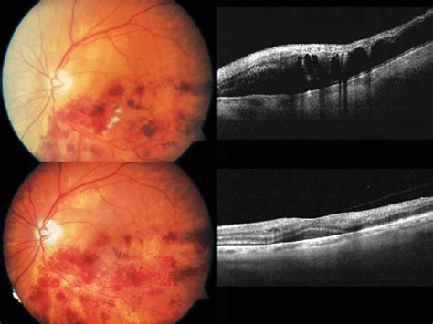 Case 2 Of Our Case Series Of Retinal Vein Occlusion Treated With Rtpa