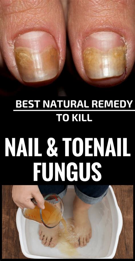 Best Nail Fungus Treatment
