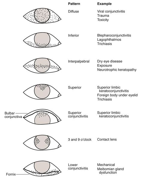 Staining Patterns Eye Facts Optometry Education Eye Health Facts