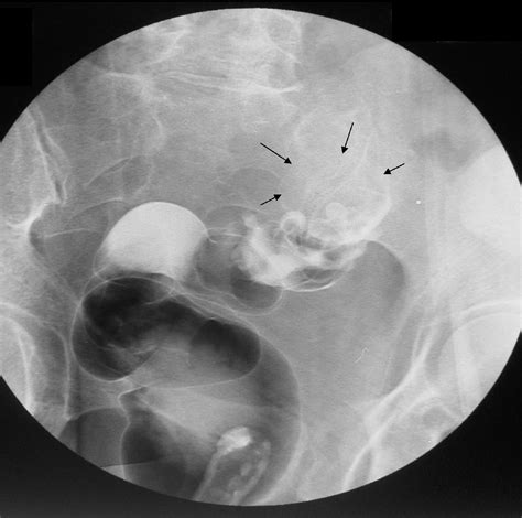 Figure 3 From Large Bowel Obstruction Secondary To Gallstone Impaction