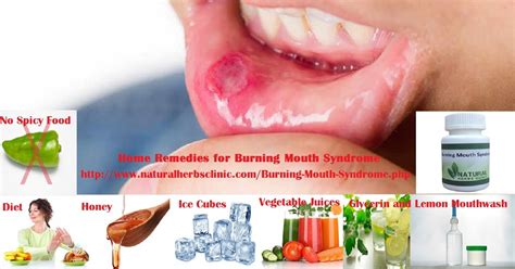 How Long Will The Burning Mouth Syndrome 6 Home Remedies For Burning