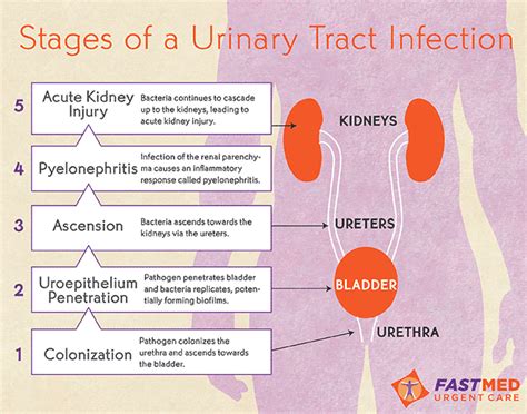 Stages Of Uti Urinary Tract Urinary Tract Infection Medical